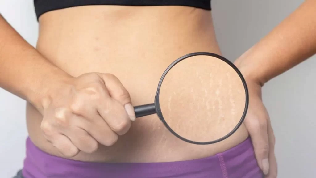 Black Castor Oil For Stretch marks: Everything You Need To Know